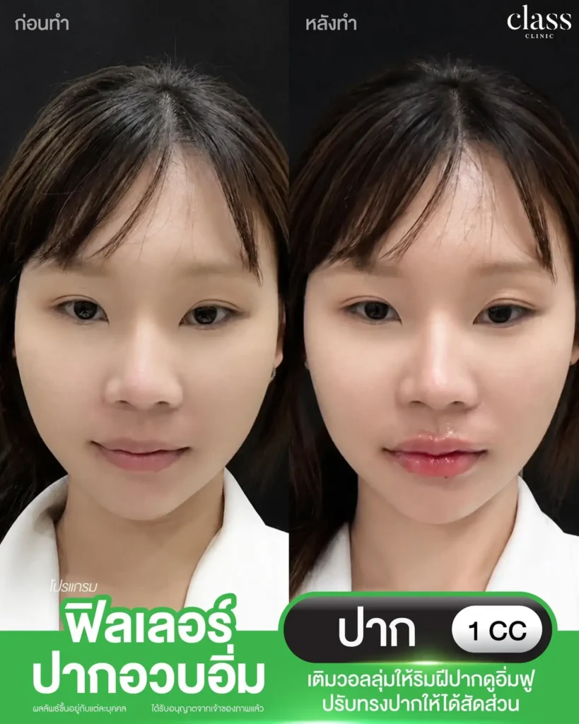 ผลลัพธ์ฟิลเลอร์ปาก ก่อนหลัง Class Clinic โคราช