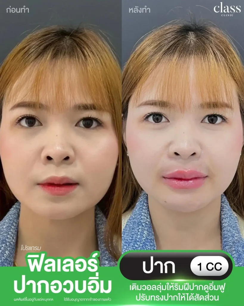 ผลลัพธ์ฟิลเลอร์ปากอวบอิ่ม Class Clinic โคราช