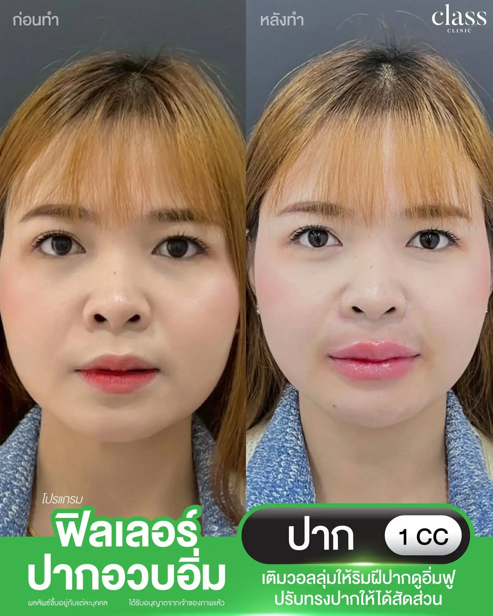 รีวิวฟิลเลอร์ปากอวบอิ่ม Class Clinic โคราช