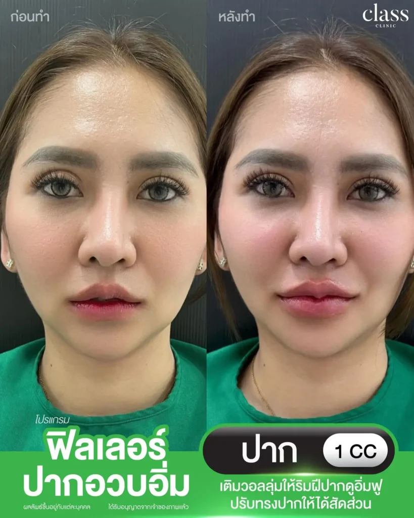 ผลลัพธ์ฟิลเลอร์ปาก คลินิกเสริมความงามโคราช