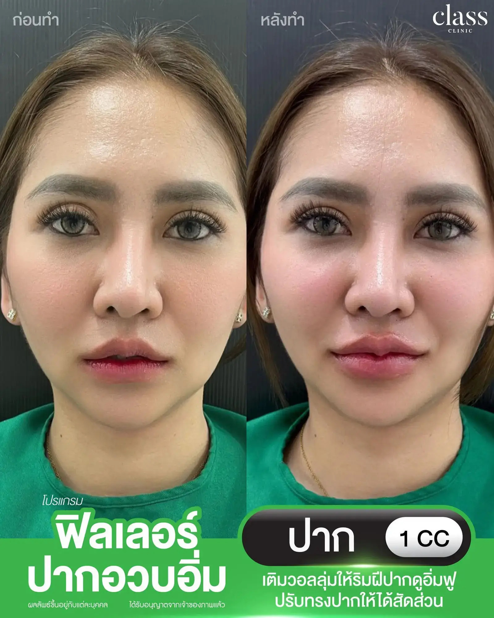 รีวิวฟิลเลอร์ปาก คลินิกเสริมความงามโคราช