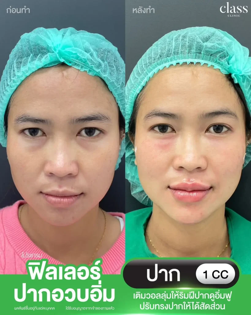 ผลลัพธ์ฟิลเลอร์ปาก Class Clinic นครราชสีมา