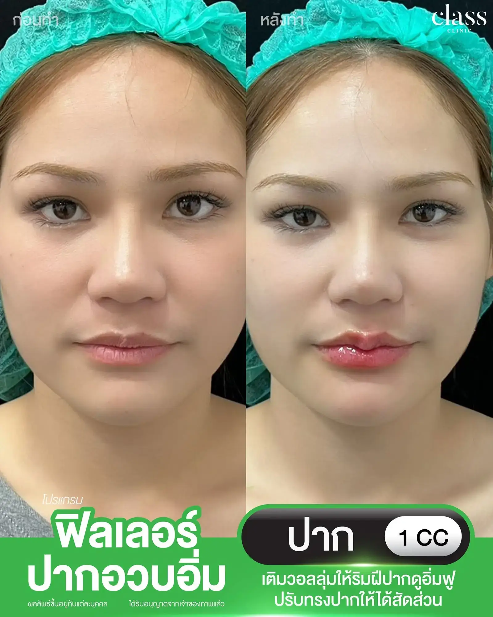 รีวิวฟิลเลอร์ปาก โคราช