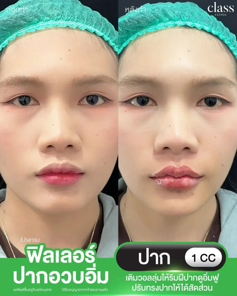 ผลลัพธ์ฟิลเลอร์ร่องแก้ม Class Clinic โคราช