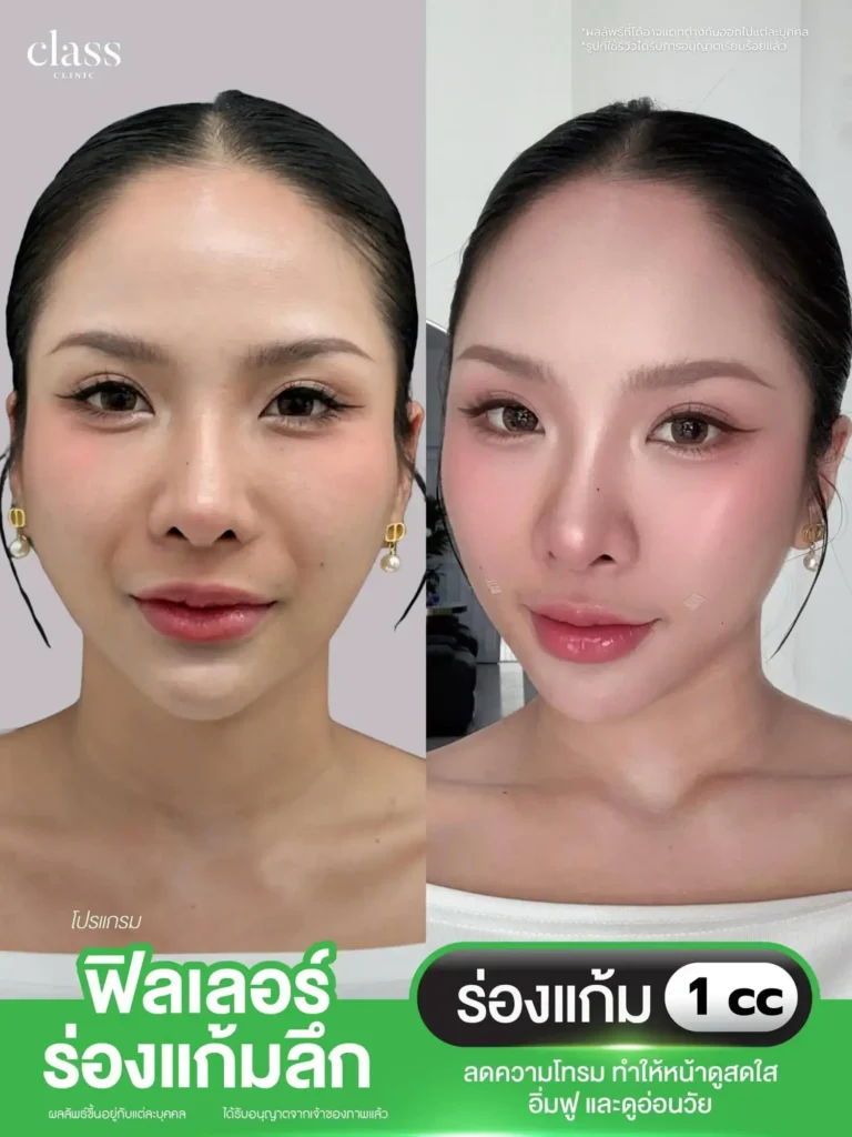 ผลลัพธ์ RE:GENE หน้าใส Class Clinic โคราช