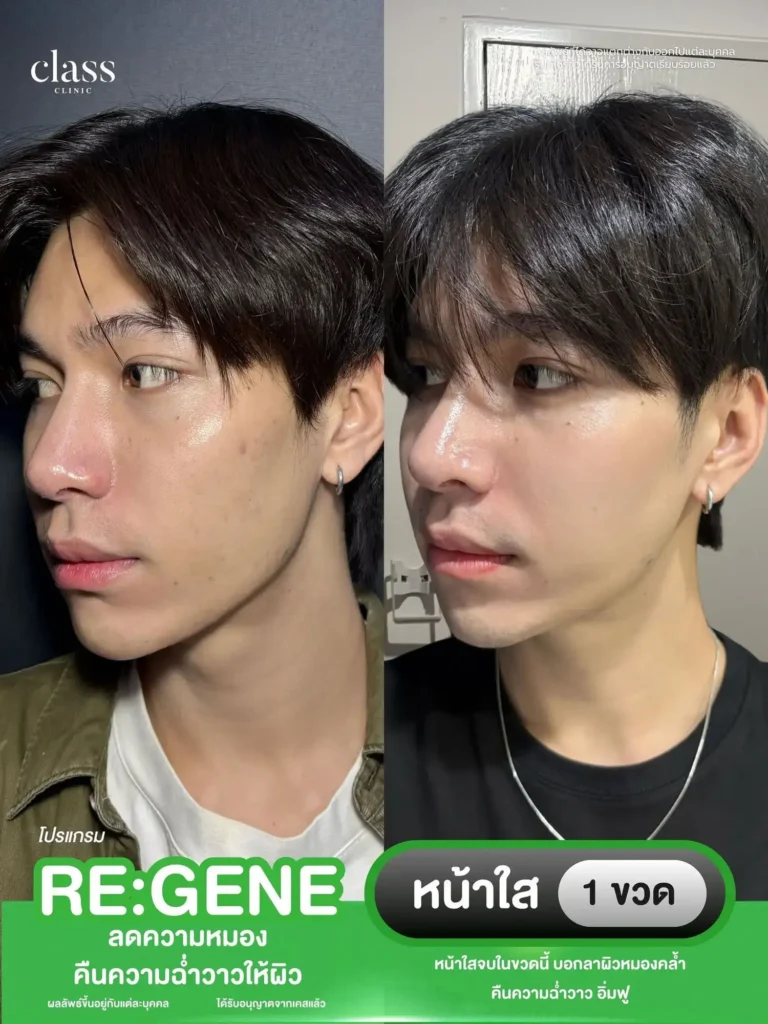 ผลลัพธ์ฟิลเลอร์แก้คางสั้น โคราช