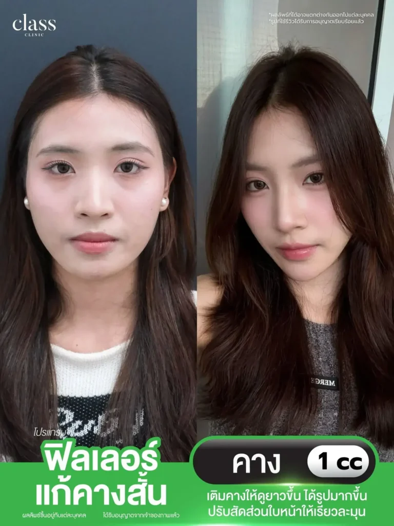 ผลลัพธ์โบท็อกซ์ริ้วรอย Class Clinic โคราช