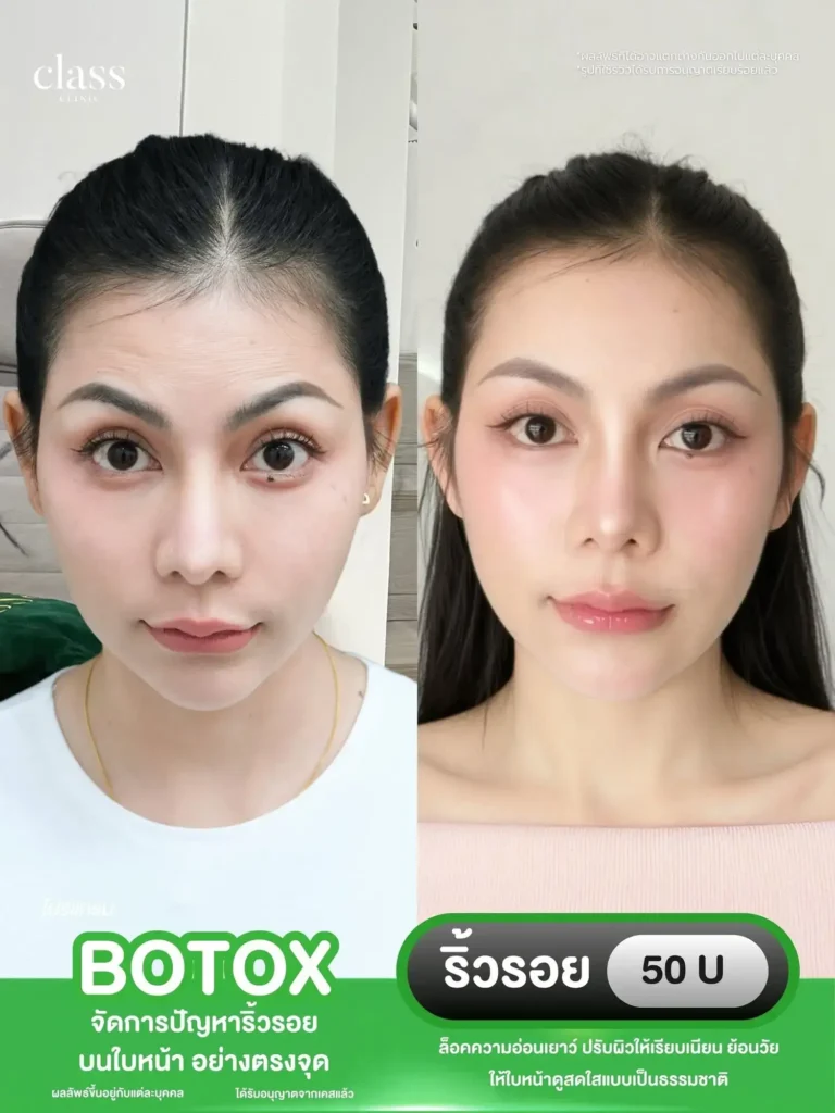 ผลลัพธ์โบท็อกซ์ลิฟกรอบหน้า โคราช