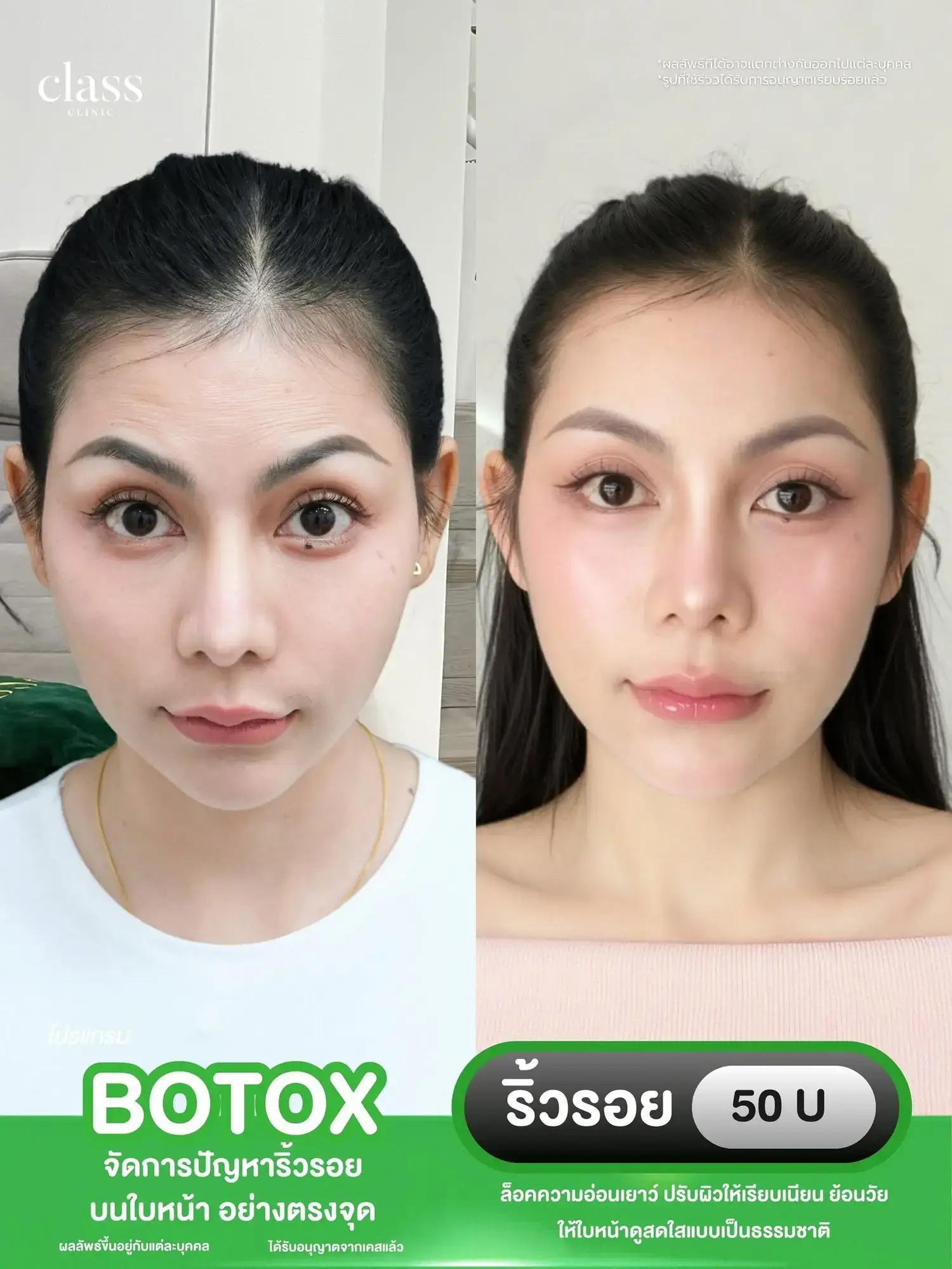 รีวิวโบท็อกซ์ยกกระชับกรอบหน้า โคราช