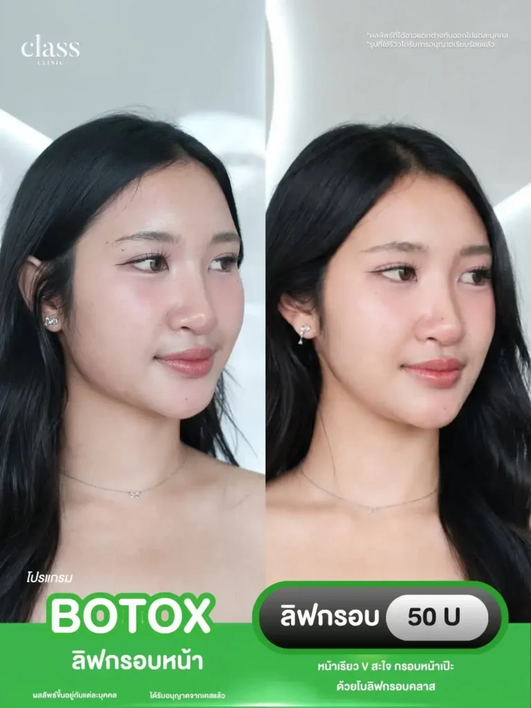 ผลลัพธ์ฟิลเลอร์ปากอวบอิ่ม โคราช