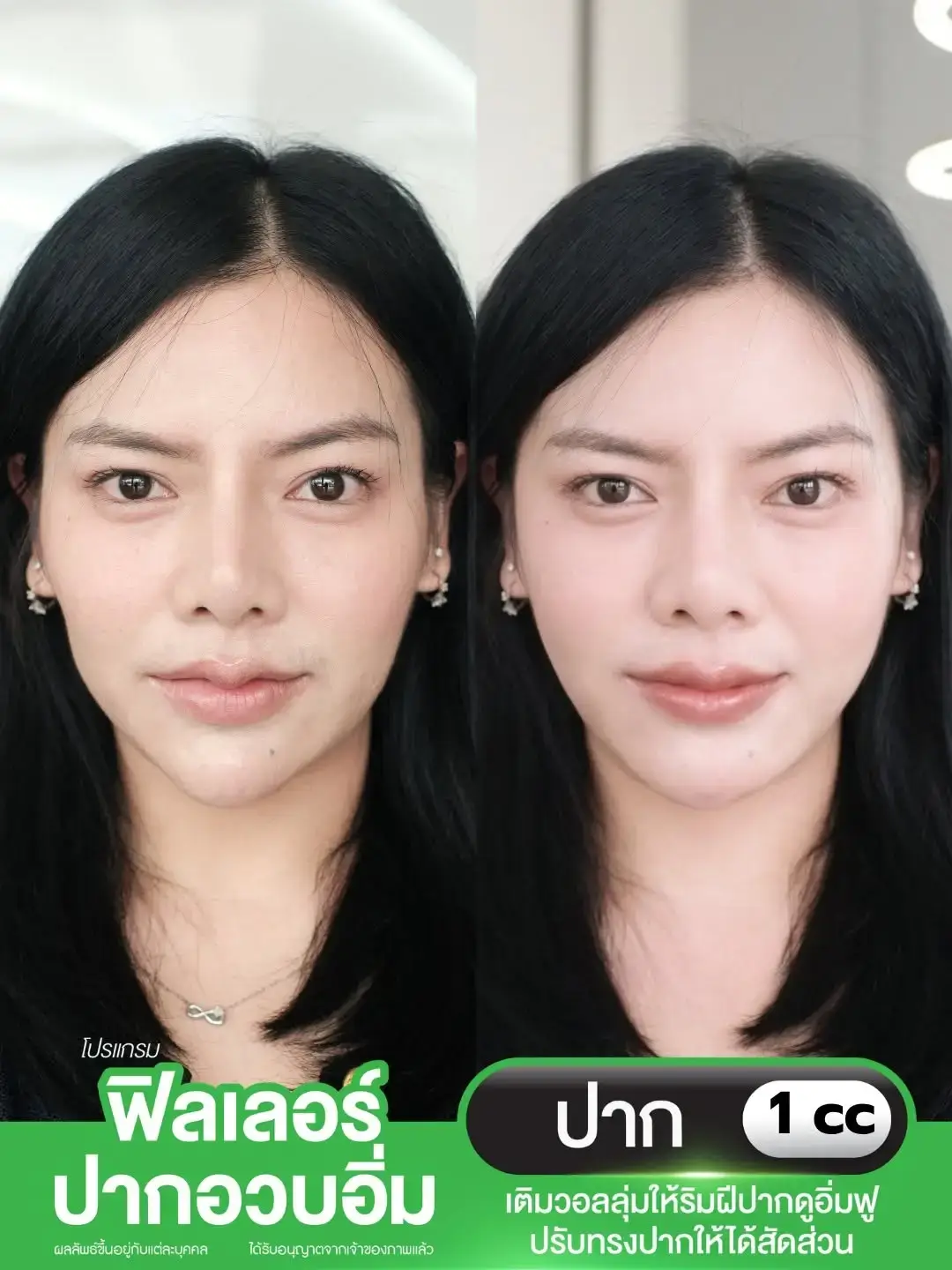 รีวิวยกกระชับ Ultraformer Class Clinic โคราช