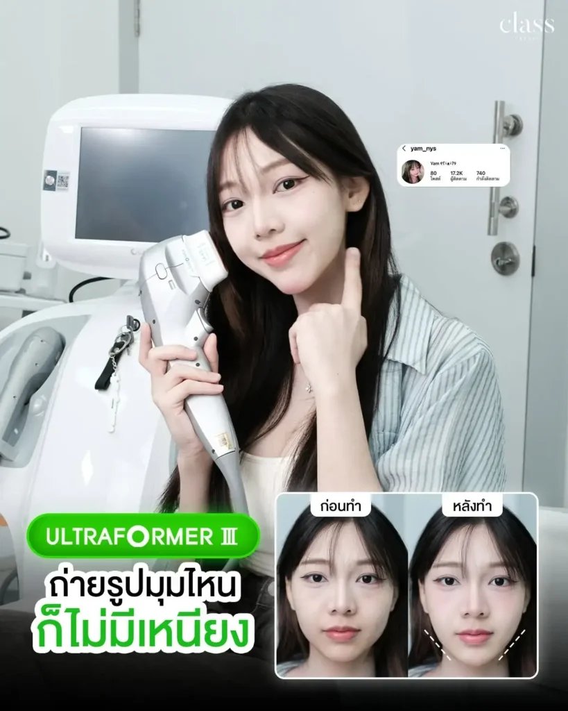 ผลลัพธ์โบท็อกซ์กราม หน้าเรียว โคราช