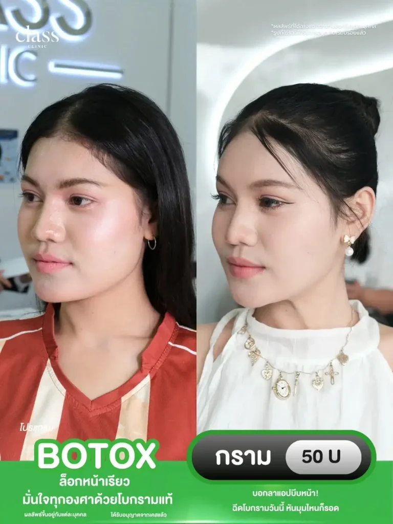 ผลลัพธ์โบท็อกซ์ Class Clinic โคราช