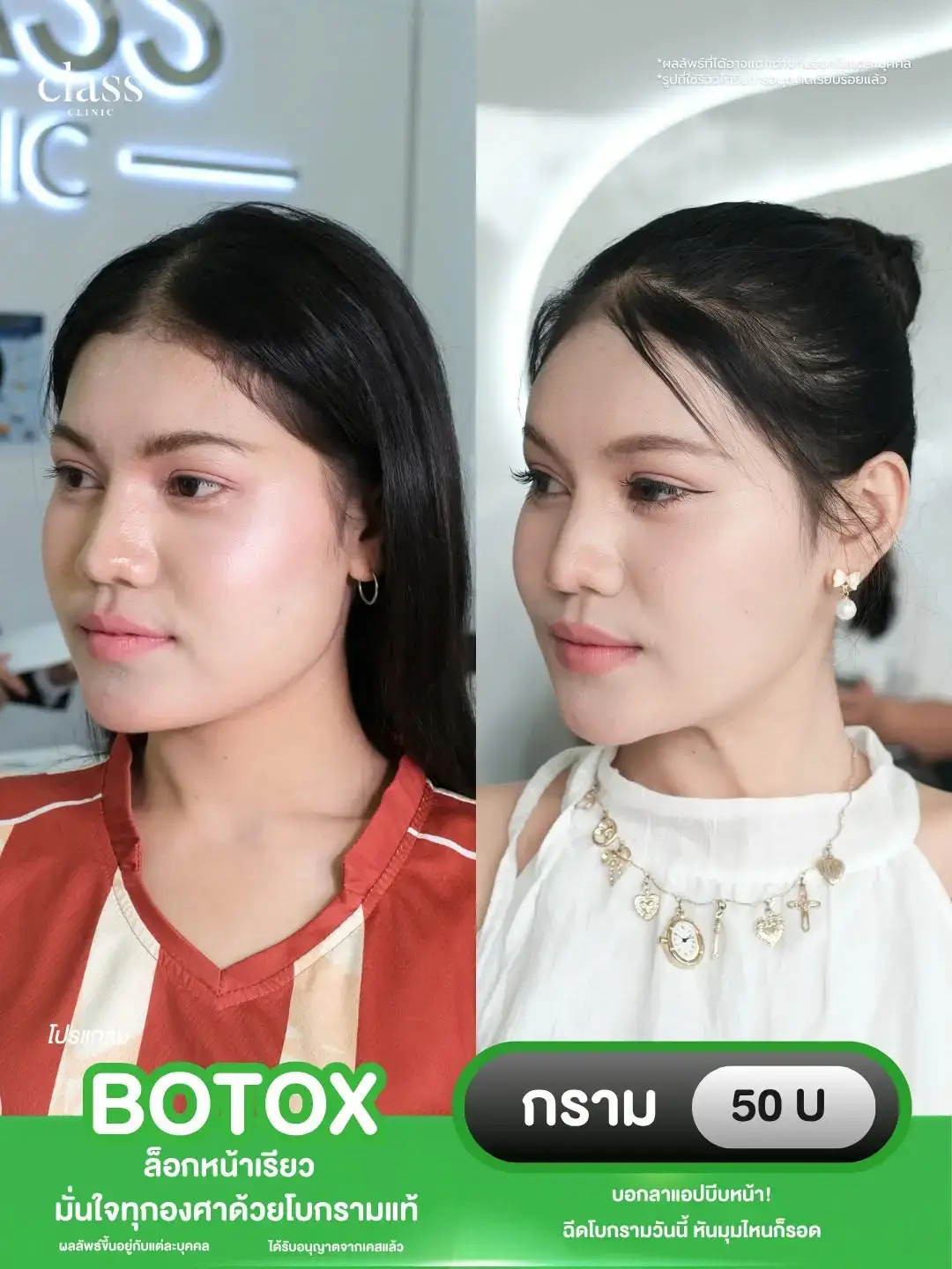 รีวิวโบท็อกซ์กราม Class Clinic โคราช