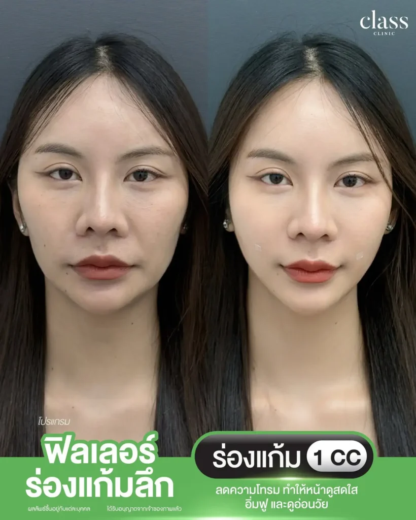 ผลลัพธ์ฟิลเลอร์ร่องแก้มลึก ก่อนหลัง Class Clinic โคราช