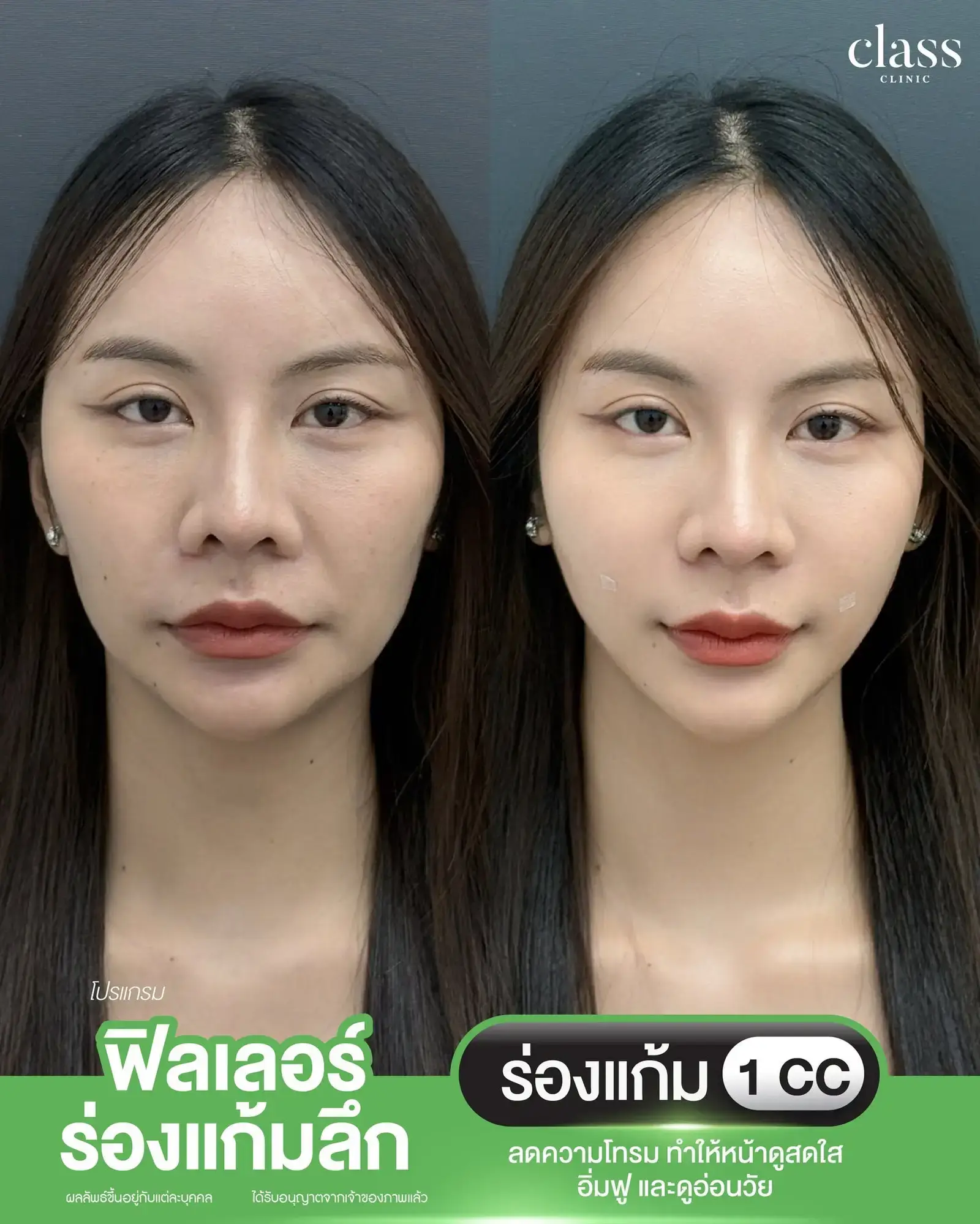 รีวิวฟิลเลอร์ร่องแก้มลึก ก่อน-หลัง Class Clinic โคราช