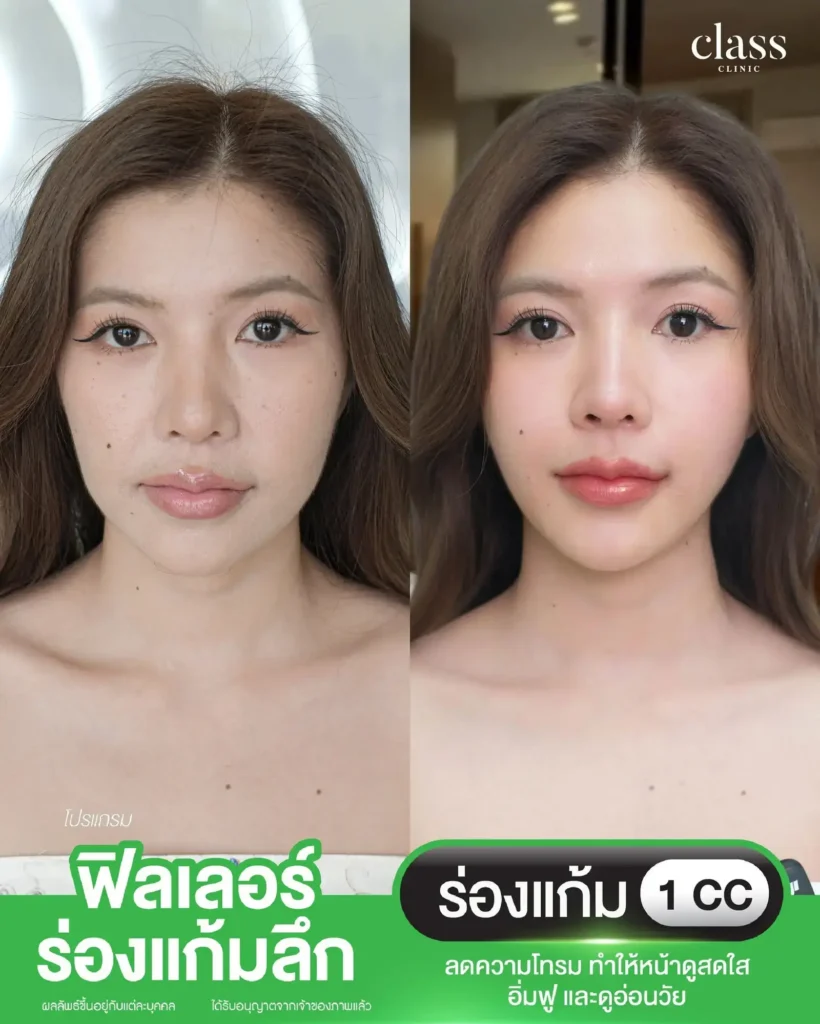 ผลลัพธ์ฟิลเลอร์ร่องแก้ม ลดความโทรม โคราช
