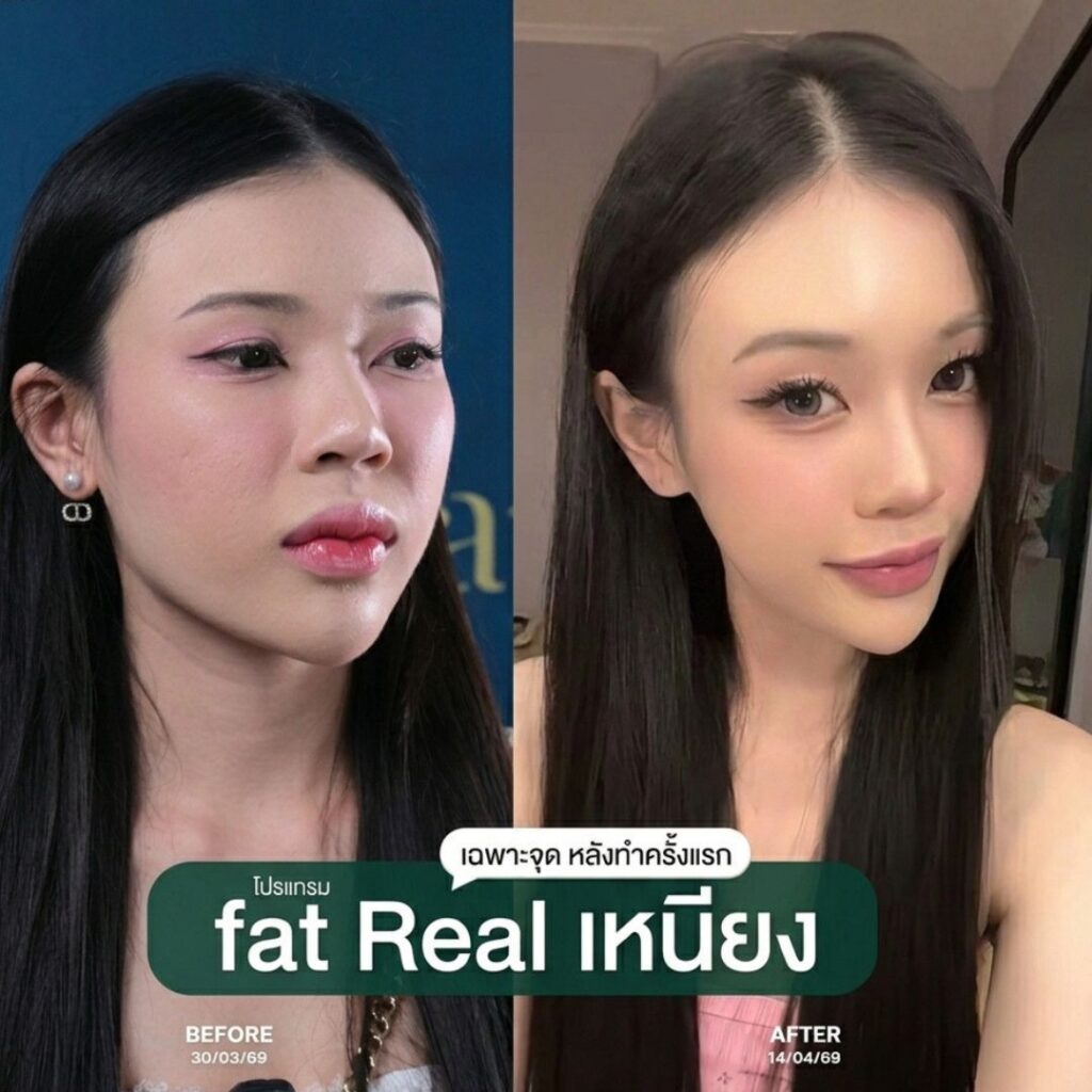 โปรแกรมฉีดแฟต